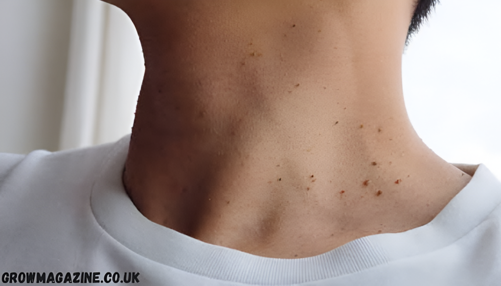 Skin Tags Caused