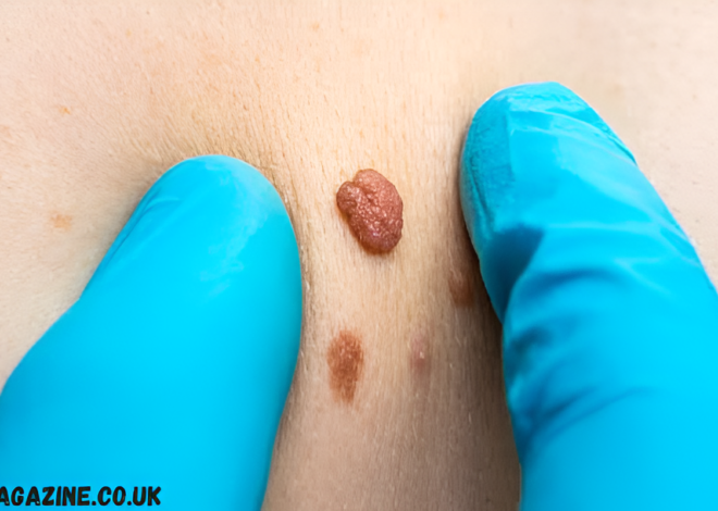 Skin Tags Caused: What Triggers Them and How to Reduce Your Risk