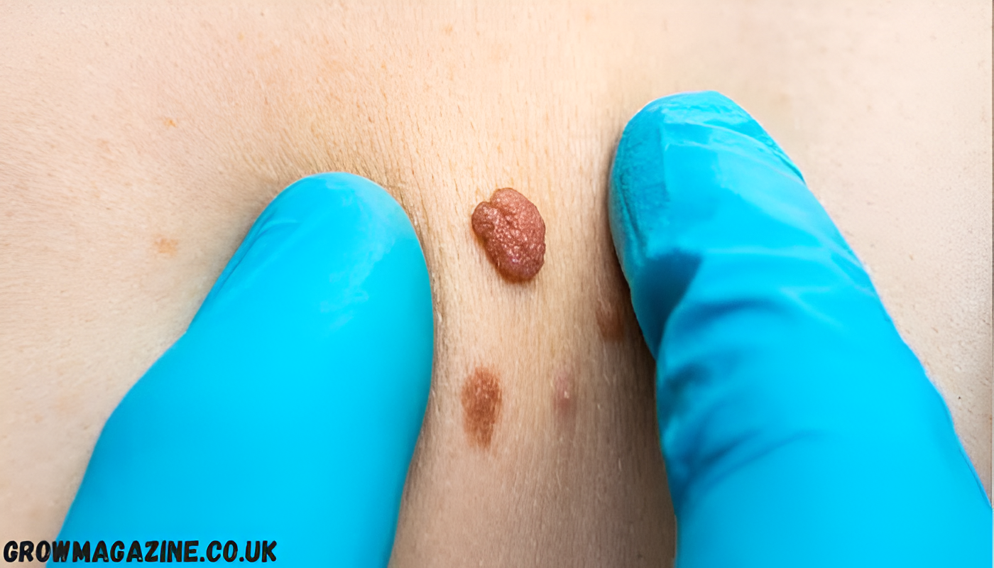 Skin Tags Caused: What Triggers Them and How to Reduce Your Risk